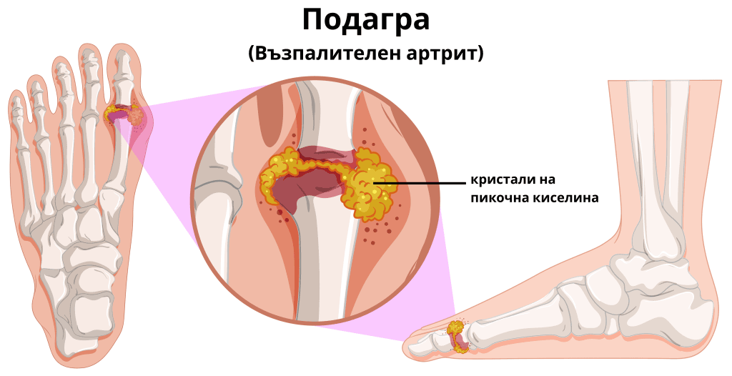 Магнезий и пикочна киселина - ТОП 6 продукта при подагра